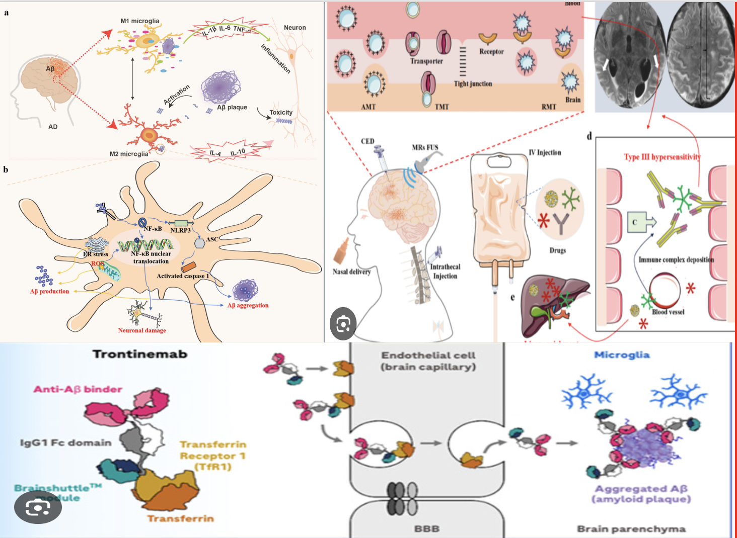 TRONTINEMAB, ALZHEIMER HASTALIĞ İÇİN YENİ BİR UMUT MU?